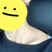 リク 蕁麻疹vsりく Grace東京