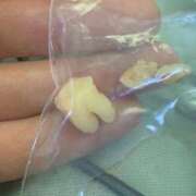 モネ 親知らず抜いたよ ソープランドMAX‐マックス-